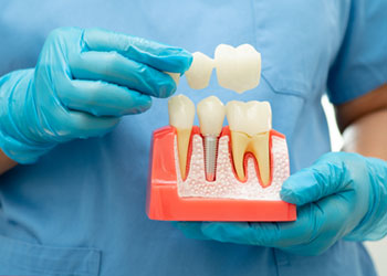 dental-implant-artificial-tooth-roots-into-jaw-r-2025-02-25-07-42-42-utc